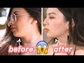 GOT RID OF MY DOUBLE CHIN✨ KYBELLA BEFORE AND AFTER EXPERIENCE / REVIEW