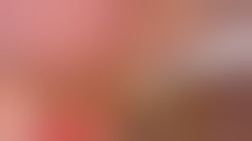 Laparoscopic choledochal cyst excision and Roux-en-Y hepaticojejunostomy