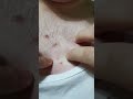 BODY ACNE