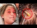 12-Year-Old Girl Complains About Irritation in Head, Doctor Makes Horrific Discovery