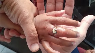 #005 - Evakuasi Pelepasan Cincin (Pada Jari Tangan Seorang Anak)