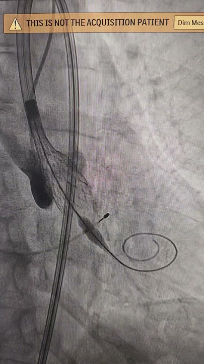Trans-catheter Aortic Valve Implantation (TAVI) or Replacement (TAVR) ♥️ Dr Binoy John