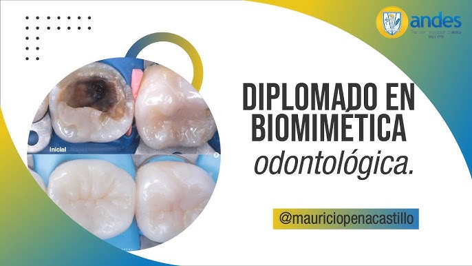 Los 3 Tipos de Cemento Dental: Los Mejores Cementos - IPG Dental