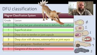 Wagner Classification of Diabetic Foot Ulcers