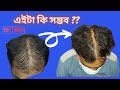 Prp treatment before  after  feedback  hair fall treatment 