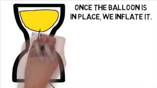 Balloon Sinuplasty Animation