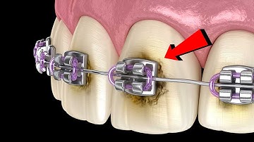 ✅Tác Hại Nguy Hiểm Khi Niềng Răng