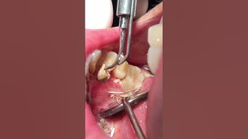 Cạo vôi răng sóng siêu âm #shorts #caovoirang #tartar