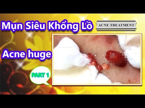 Video Cách điều trị mụn viêm, mụn bọc hiệu quả nhất TPHCM. - youtube