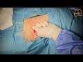 TOS Supraclavicular approach-Non Edited Video