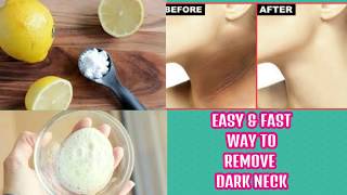 How to get rid of dark neck fast and easy way
