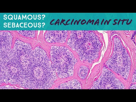 squamous cell carcinoma in situ histology