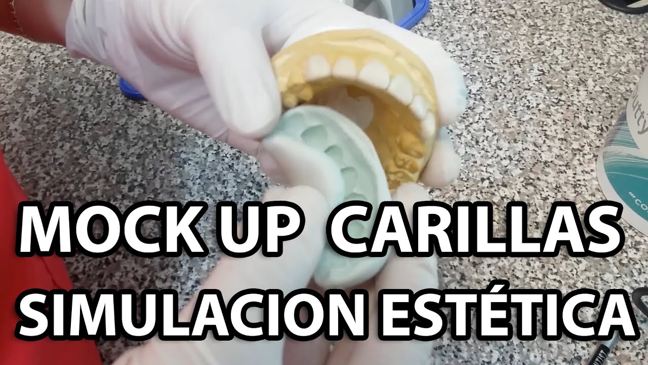 Simulación Estética #mockup👅 para #carillasdeporcelana #carillasdentales