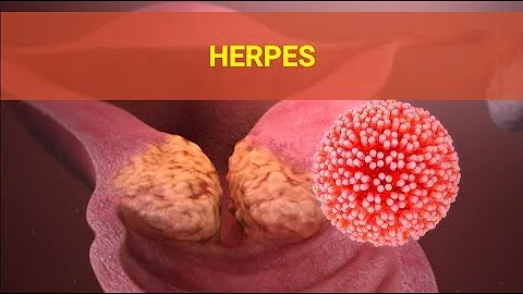 Herpes Symptoms – Causes Symptoms and Pictures of HSV Herpes Cold Sores in Men women