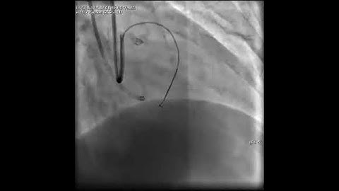 Aortic dissection and radial rupture during retrograde CTO PCI: Management of complications VİDEO 3
