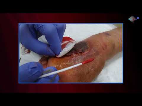 WCW: Treatment of Skin Avulsion Injury