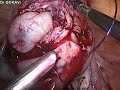 Laparoscopic myomectomy for a submucous fibroid 