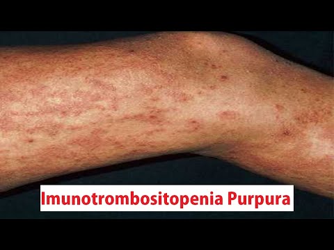Imunotrombositopenia Purpura (ITP) | Penyakit Autoimun | Healthy | Belajar Ilmu Kesehatan