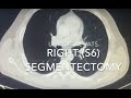 Uniportal vats right s6 segmentectomy