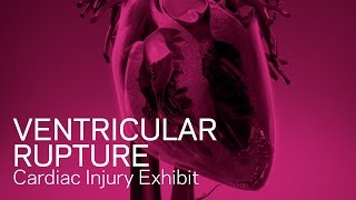 Ventricular Rupture - Cardiac Injury Animation