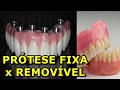 Protese fixa ou Removível? QUAL MELHOR?