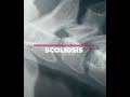 What Causes Scoliosis? The #1 Risk Factor Explained
