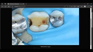 Tooth Restoration Type Voting Application screenshot 1