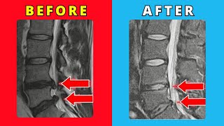 Lumbar Disc Extrusion L3 L4 & L4 L5 healed without surgery