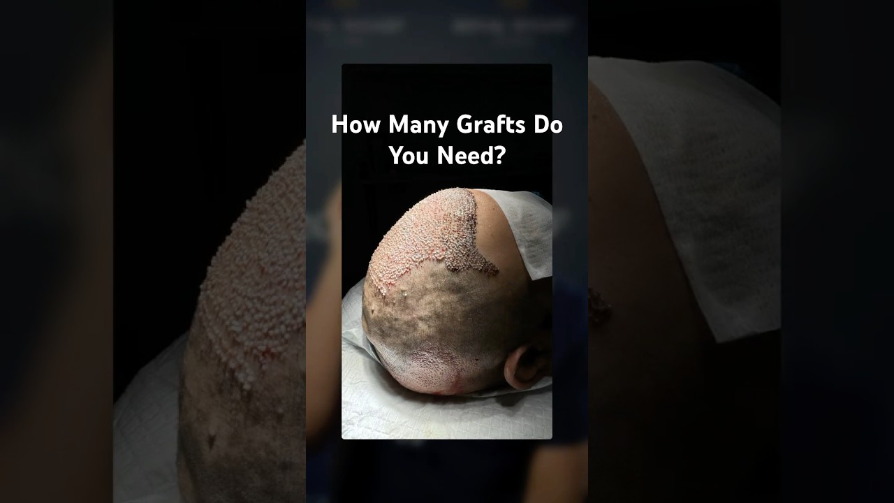 🔍 How Many Grafts Do You Actually Need for a Hair Transplant?
