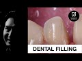 DENTAL FILLING | DENTIST | DR RIZAL RIZKY AKBAR