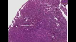 Histopathology LungSmall cell carcinoma