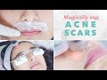 Get Rid of Acne Scars Pigmentation & Blemishes  Picosure Laser
