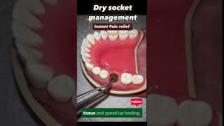 Dry Socket Treatment