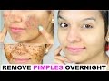 Remove Pimples OVERNIGHT | 100% Success | Anaysa