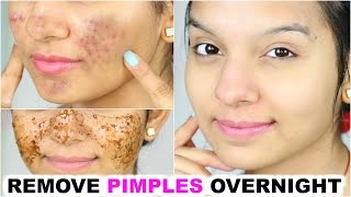 Remove Pimples OVERNIGHT | 100% Success | Anaysa