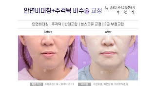 안면비대칭+주걱턱비수술교정(안면비대칭/주걱턱/반대교합/본스크류교정/3급부정교합) B&amp;A [연산,명지,다대포,영도교정치과 - 뉴욕스마일치과의원]