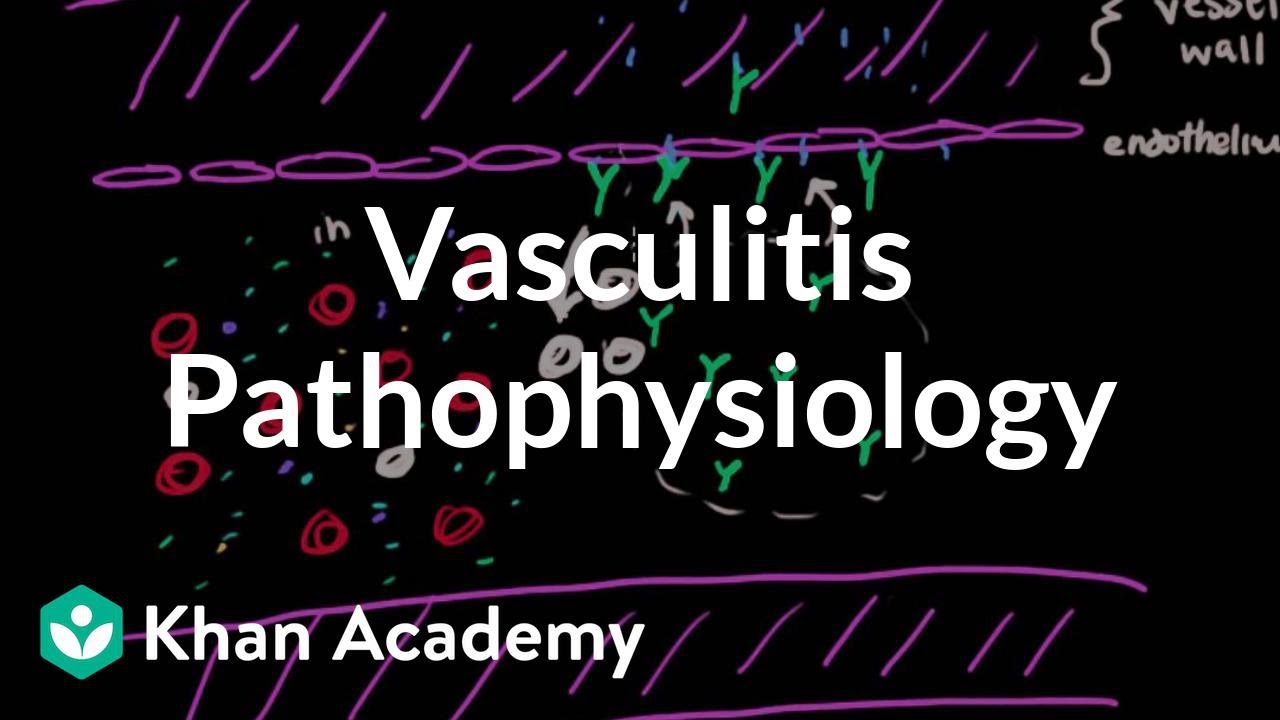Vasculitis pathophysiology | Circulatory System and Disease | NCLEX-RN | Khan Academy