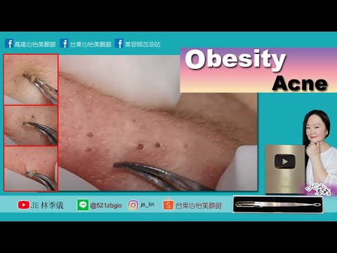 Je acne #肥滋滋黑頭粉刺 #無痛清粉刺 #LBRY #高雄心怡美顏館 #美容師必學的針清技術