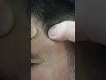 face acne
