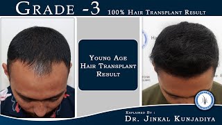 Best Hair Transplant Result || Grade-3 Baldness Hair Transplant Result ||Hairfree Hairgrow Surat