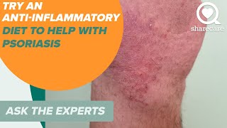 Try an Anti inflammatory Diet to Help with Psoriasis | Ask the Experts | Sharecare How Effective Are Biologics For Psoriasis Ask The Experts Sharecare