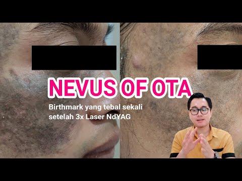 Video: Apakah yang menyebabkan nevus?