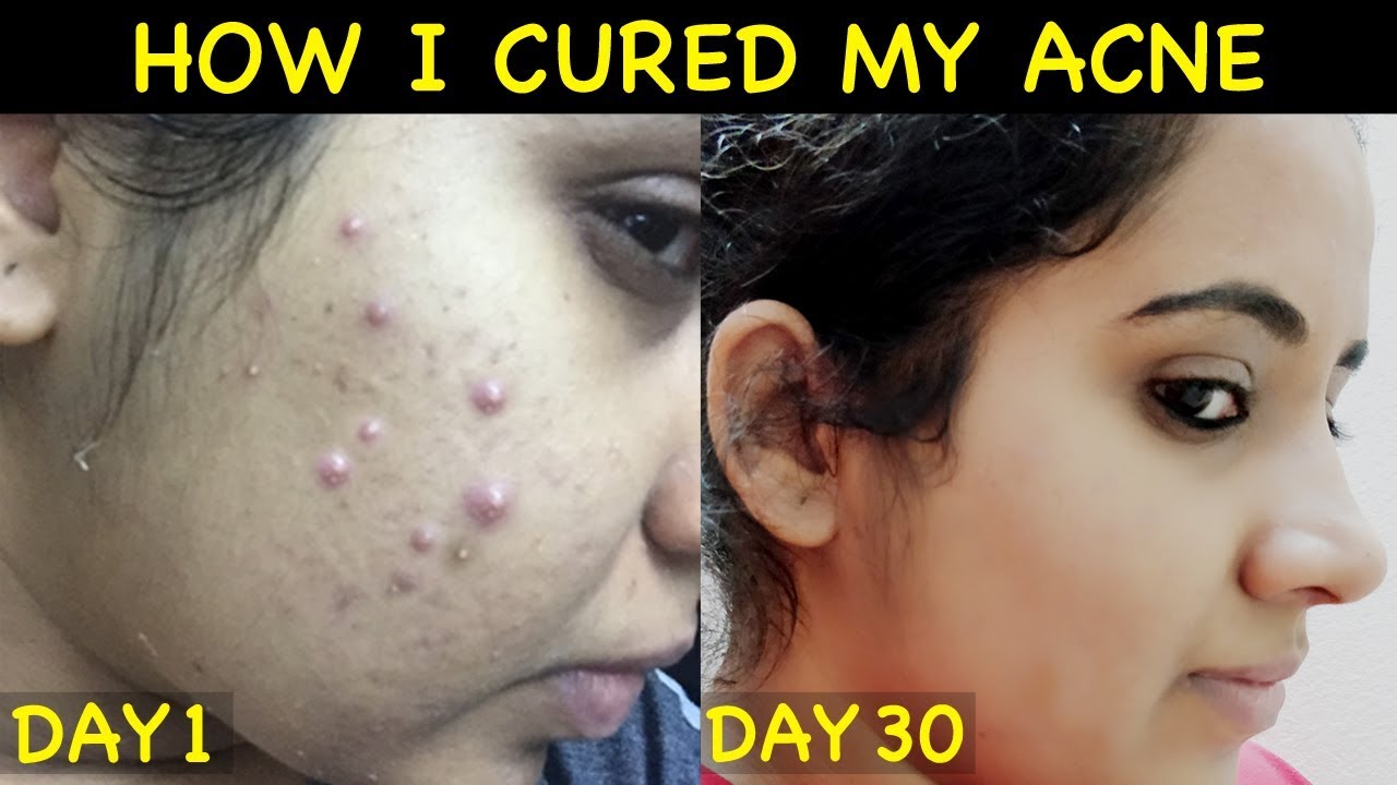 How I Cleared My Acne in 30 Days | How I Cured My Acne ...