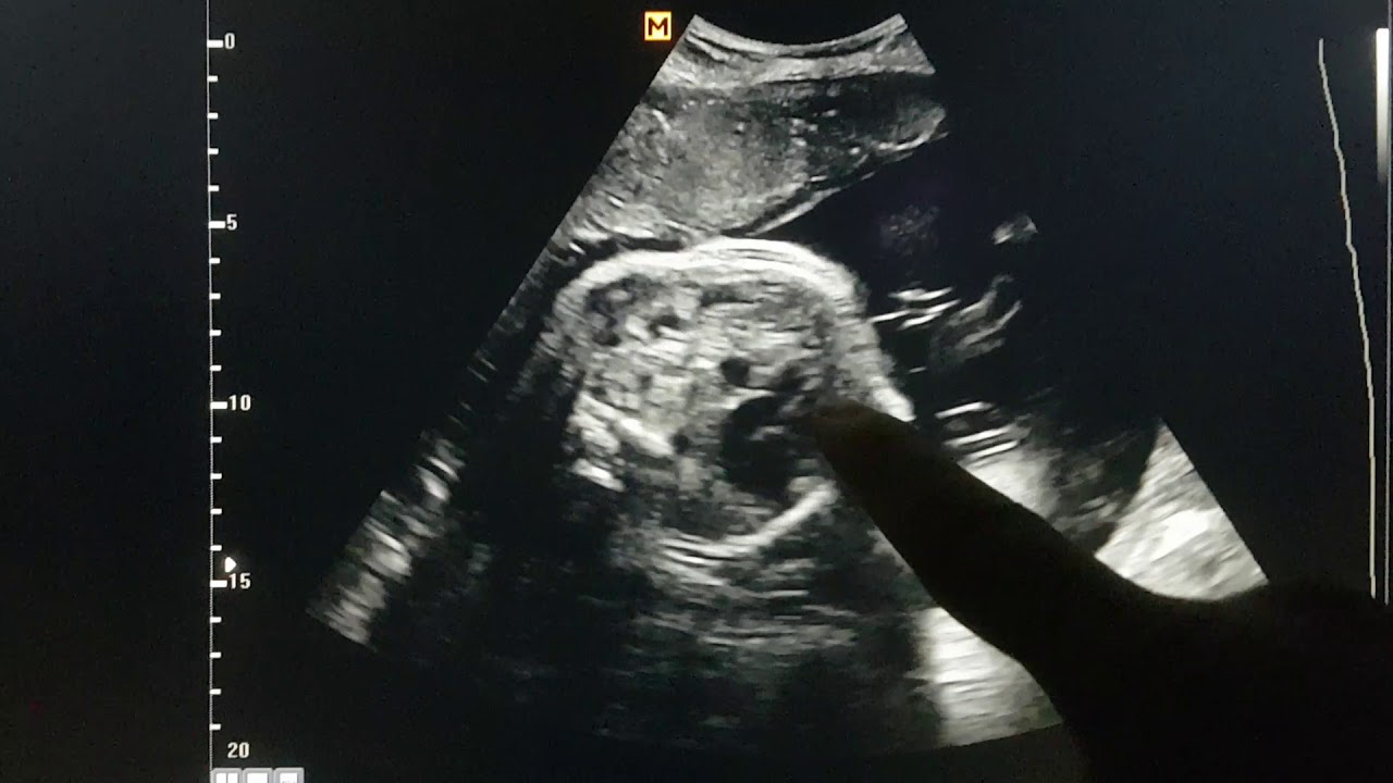 Fetal Diaphragmatic Hernia Sonography YouTube