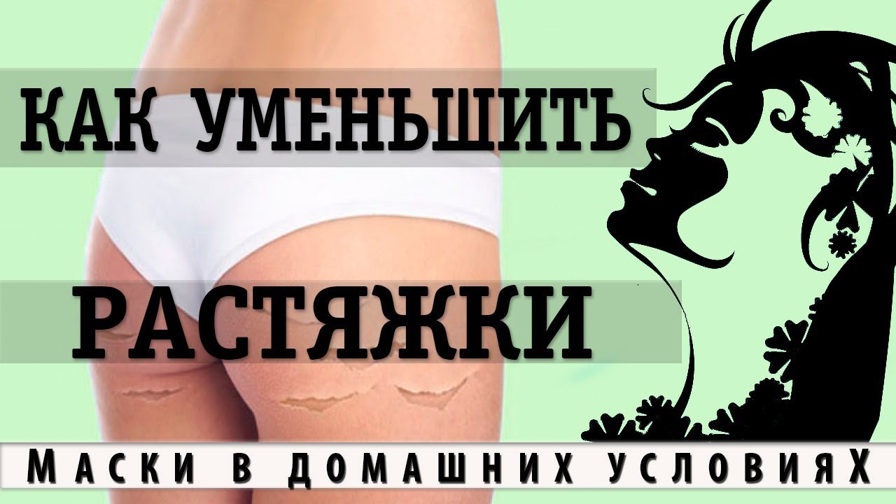 Как уменьшить растяжки ( стрии) на теле - YouTube