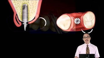 204-00 Soft Tissue Grafting for Implant Complications in the Esthetic Zone PREVIEW