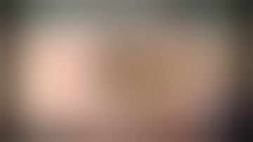 CataractCoach™ 2084: aangepaste twist-and-out IOL-explantatietechniek