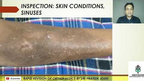 NON UNION TIBIA: Ideal Case Presentation Rapid Revision of Orthopaedics by Dr. Prateek Joshi