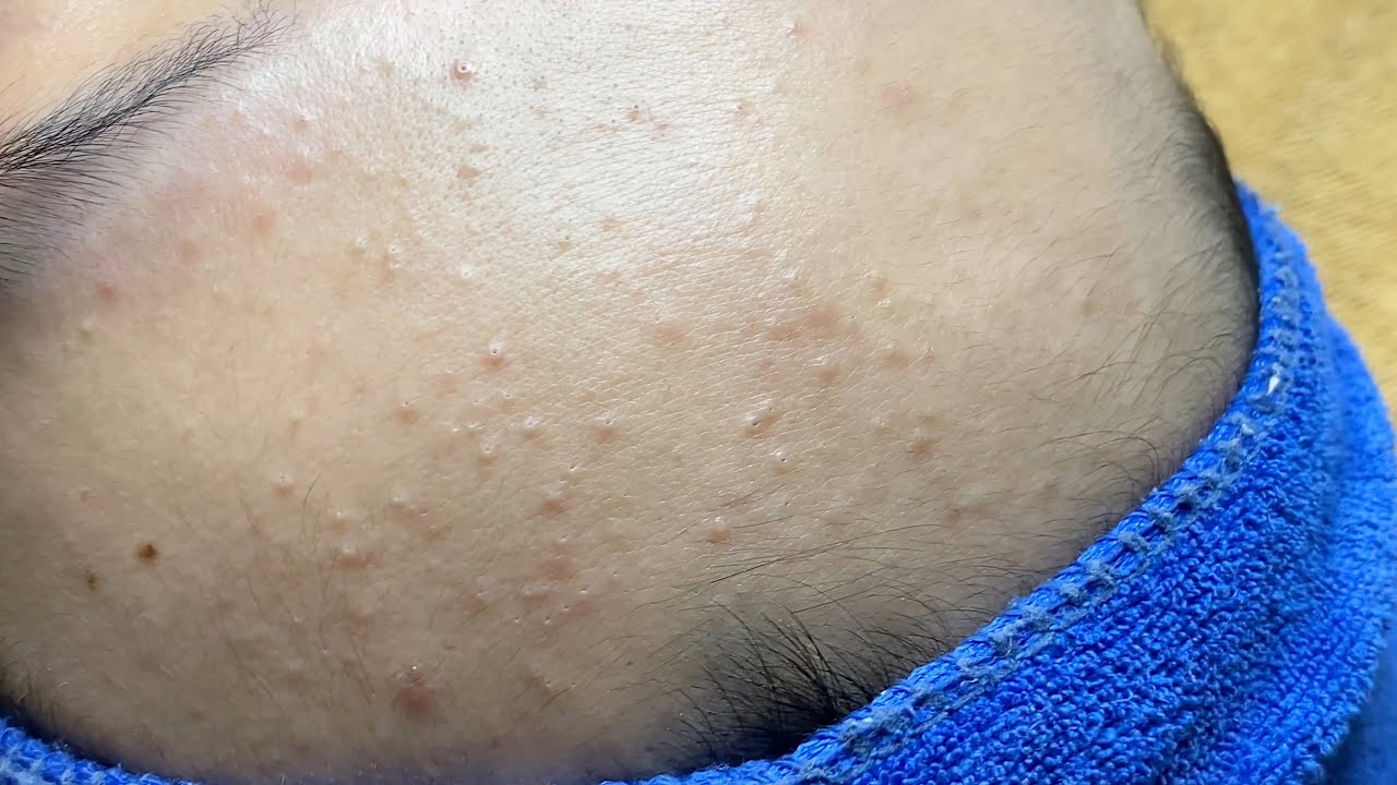 Forehead Pimples | Mụn Trên Trán - SacDepSpa#315