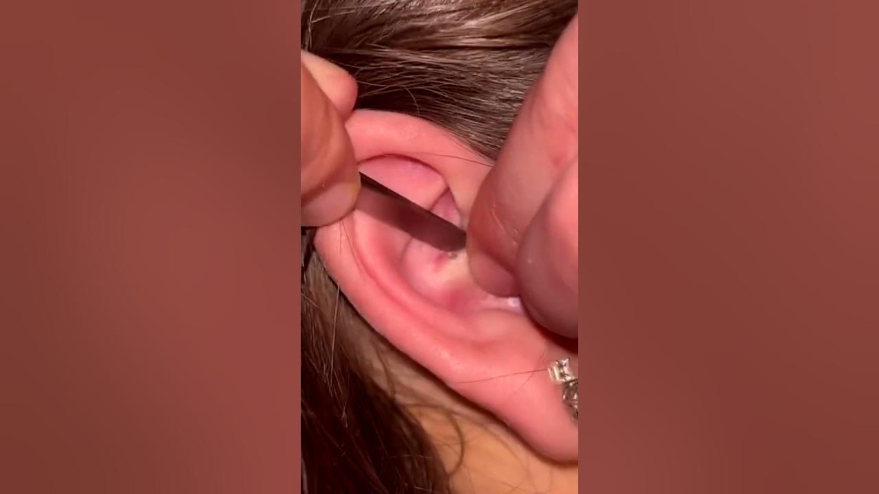 New pimple extraction videos Loan nguyen new pimple popping videos